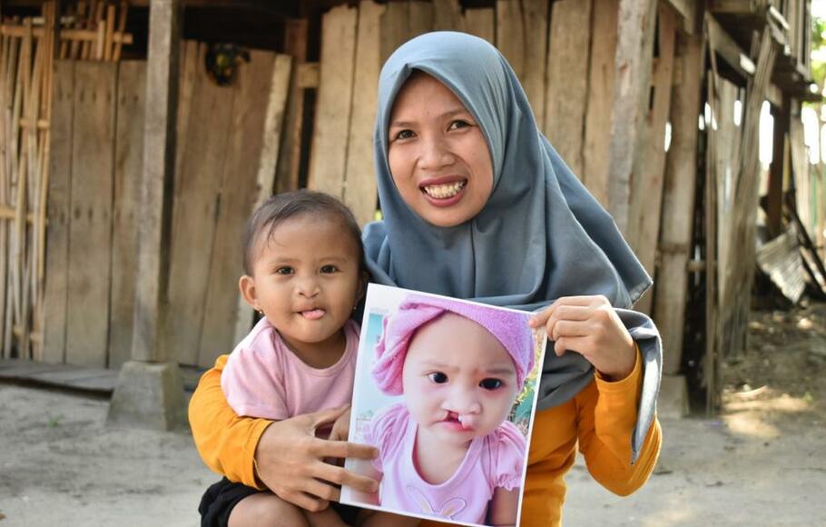 Gratis-!-Operasi-Bibir-Sumbing-Ini-Syarat-Dan-Jadwalnya